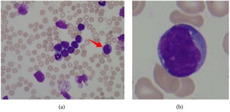 Acute Lymphoblastic Leukemia | Concise Medical Knowledge