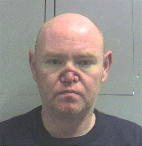 Cocaine Habit So Bad His Nose Collapsed - Picture | eBaum's World