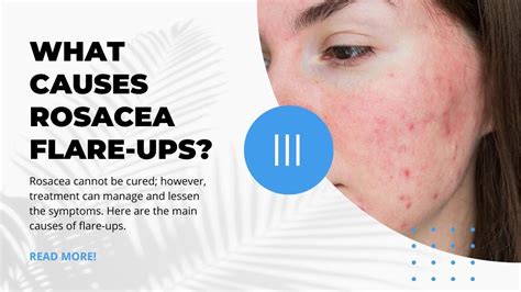 Main Causes of Rosacea Flare-Ups – Associated Dermatologists