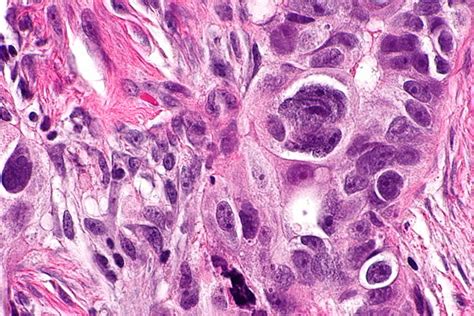 Serous carcinoma of the ovary - Libre Pathology