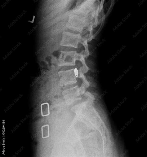 Film x ray or radiograph of a lumbar vertebrae anterior posterior AP slightly oblique view ...