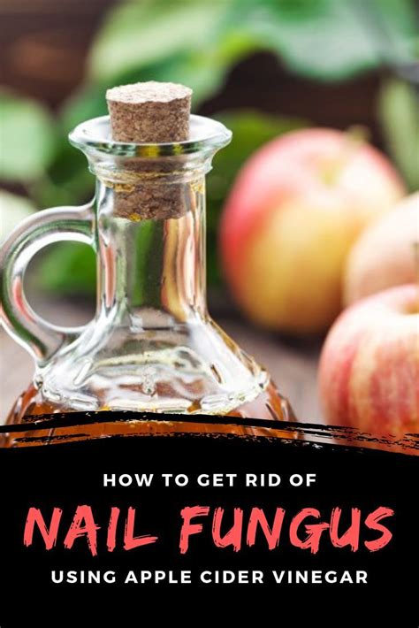 Does Apple Cider Vinegar Help Against Nail Fungus? | Nail fungus, Nail ...