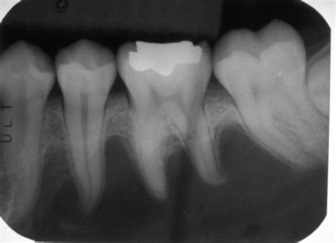 Simple Bone Cyst – Dr. G's Toothpix