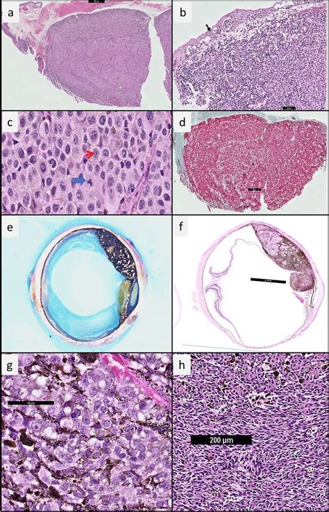 Histology of conjunctiva melanoma in a Chinese woman and histology of... | Download Scientific ...