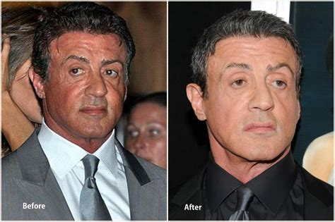 Sylvester Stallone Plastic Surgery Before and After