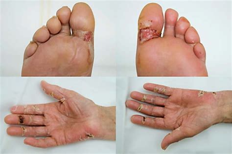 Palmar-plantar erythrodysesthesia: blistering/ulceration of hands and... | Download Scientific ...