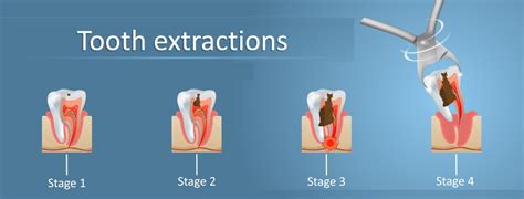 Tooth Extraction | Huntington Beach, CA | Pain relief with Oral surgery ...