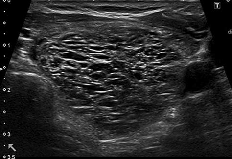 EU-TIRADS 2: spongiform nodule. Transverse plane. | Download Scientific Diagram