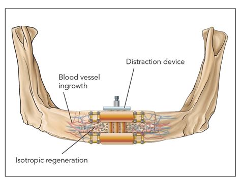 2 – A New Biologic Classification of Bone Augmentation | Pocket Dentistry