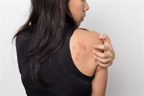 Acute Urticaria: Symptoms, Causes, and Treatment