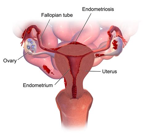 Endometriosis - AmritLaisenia