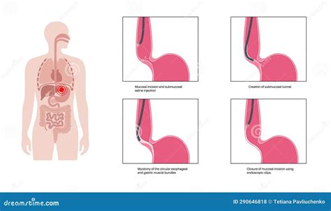 POEM medical poster stock vector. Illustration of vector - 290646818