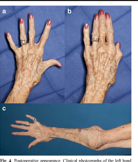 Cubitus valgus and tardy ulnar nerve palsy due to an intracapsular ...