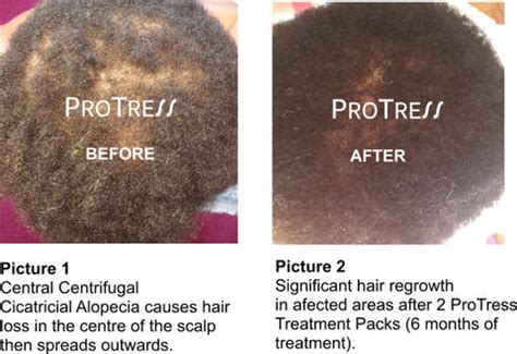 Central Centrifugal Cicatricial Alopecia Treatment – ProTress Hair Care