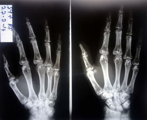 Spotted Bone - A Spot Diagnosis | British Journal of Medical Practitioners