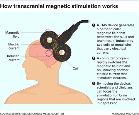 How transcranial magnet | Free educational graphics | Flickr