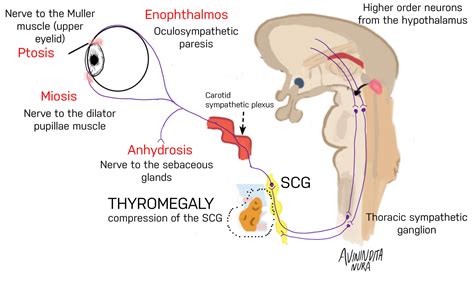 Horner Syndrome Mnemonic - My Endo Consult