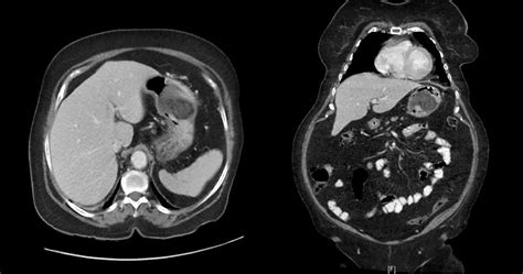 A CT scan of the abdomen showed a hypodense lesion measuring 6 × 6 ×... | Download Scientific ...