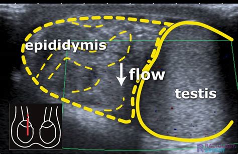 Scrotal ultrasound