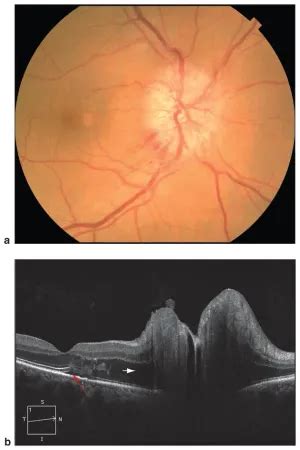 Nonarteritic anterior ischemic optic neuropathy (NAION) - American ...