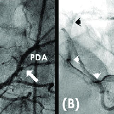 -Left Coronary Artery Angiogram. In this coronary angiogram of the left... | Download Scientific ...