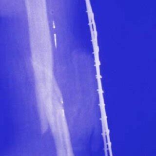 X-ray of fracture of left upper arm. | Download High-Resolution ...