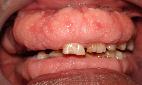 Full Text - Hereditary gingival fibromatosis: Report of four generation pedigree - International ...