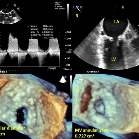 A-D: 2D and 3D image revealed restrictive small annuloplasty ring and ...