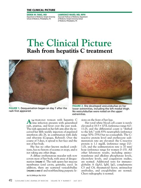 Hepatitis C Rash