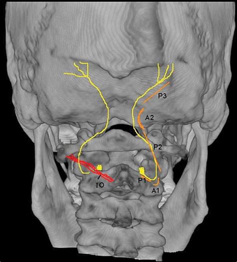 Occipital Nerve Mri