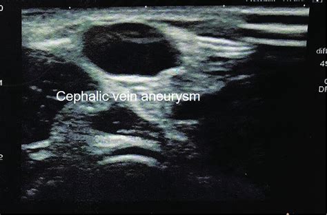 Aneurysmatic dilation of the cephalic vein in the elbow fold seen by ...