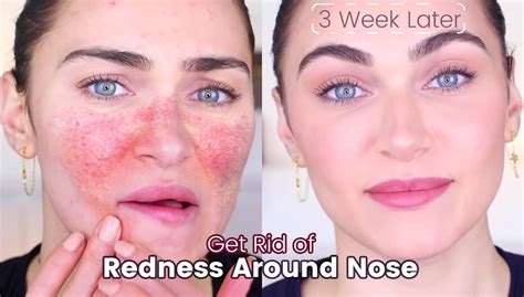 How To Get Rid Of Redness Around Nose - Health For Best Life