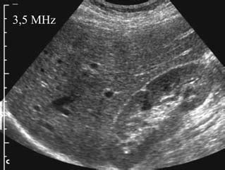 1a–d. Ultrasound attenuation in the tissue and its correction by the ...