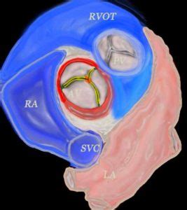 Annulus | Aorta