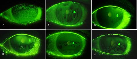 Figure 2 from Tear Film-Oriented Diagnosis and Tear Film-Oriented Therapy for Dry Eye Based on ...