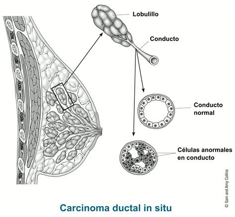 Carcinoma ductal in situ | American Cancer Society