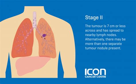 Stage 2 Of Lung Cancer