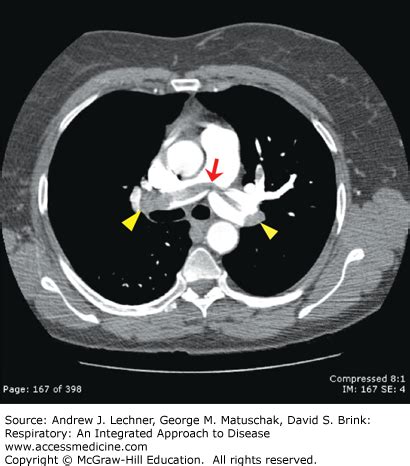 Pulmonary Embolism on CT Angiography | AccessMedicine Network