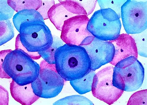 Pathology Art Print: Koilocytes, PAP Smear, LSIL - Etsy