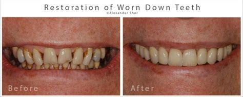 Tooth Wear Treatment Seattle - Shor Dental