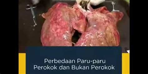 Perbedaan kondisi paru-paru perokok dan bukan perokok brainly