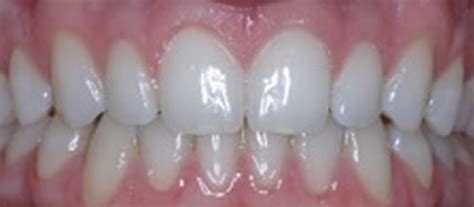 Braces Before and After | Lingual Braces & Invisalign | The London ...