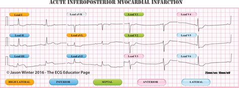 ECG Educator Blog : Acute coronary syndrome and infarctions