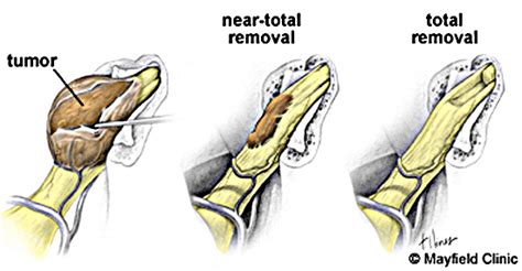 Acoustic Neuroma Association Australia | Treatment