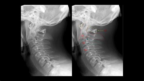 Hangman's Fracture - StoryMD