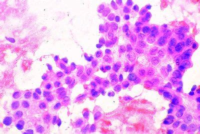 Aspiration cytology smear of centrifuged pericardial fluid showing ...