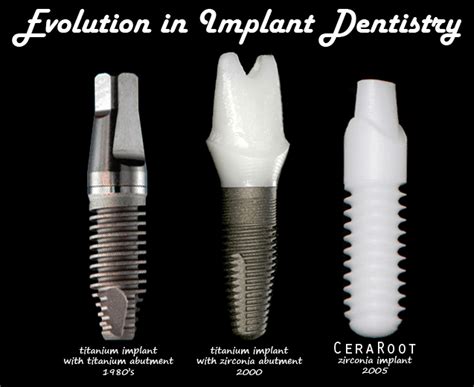 Dental Implants Columbia, SC | Zirconia Implants | Smile Columbia