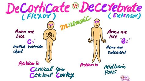 Decorticate Vs Decerebrate Rigidity,Mnemonic for USMLE | Mnemonics, Nursing mnemonics, Atrial ...