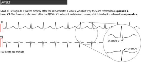 Figure 3. AVNRT in a 20-year old male suffering from palpitations. – ECG learning