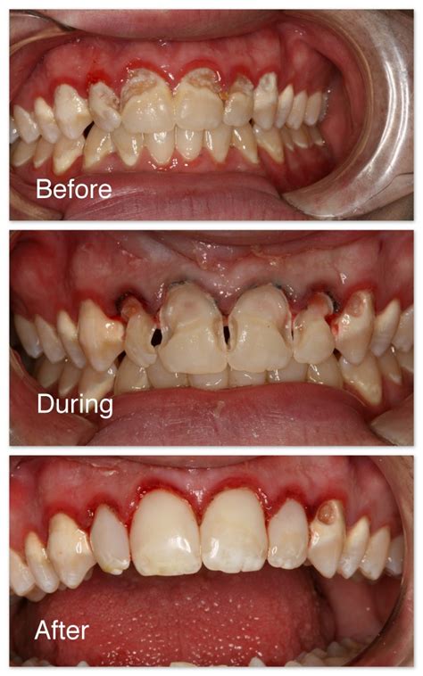 Tooth Colored Fillings Gallery - Hosner Family Dentistry